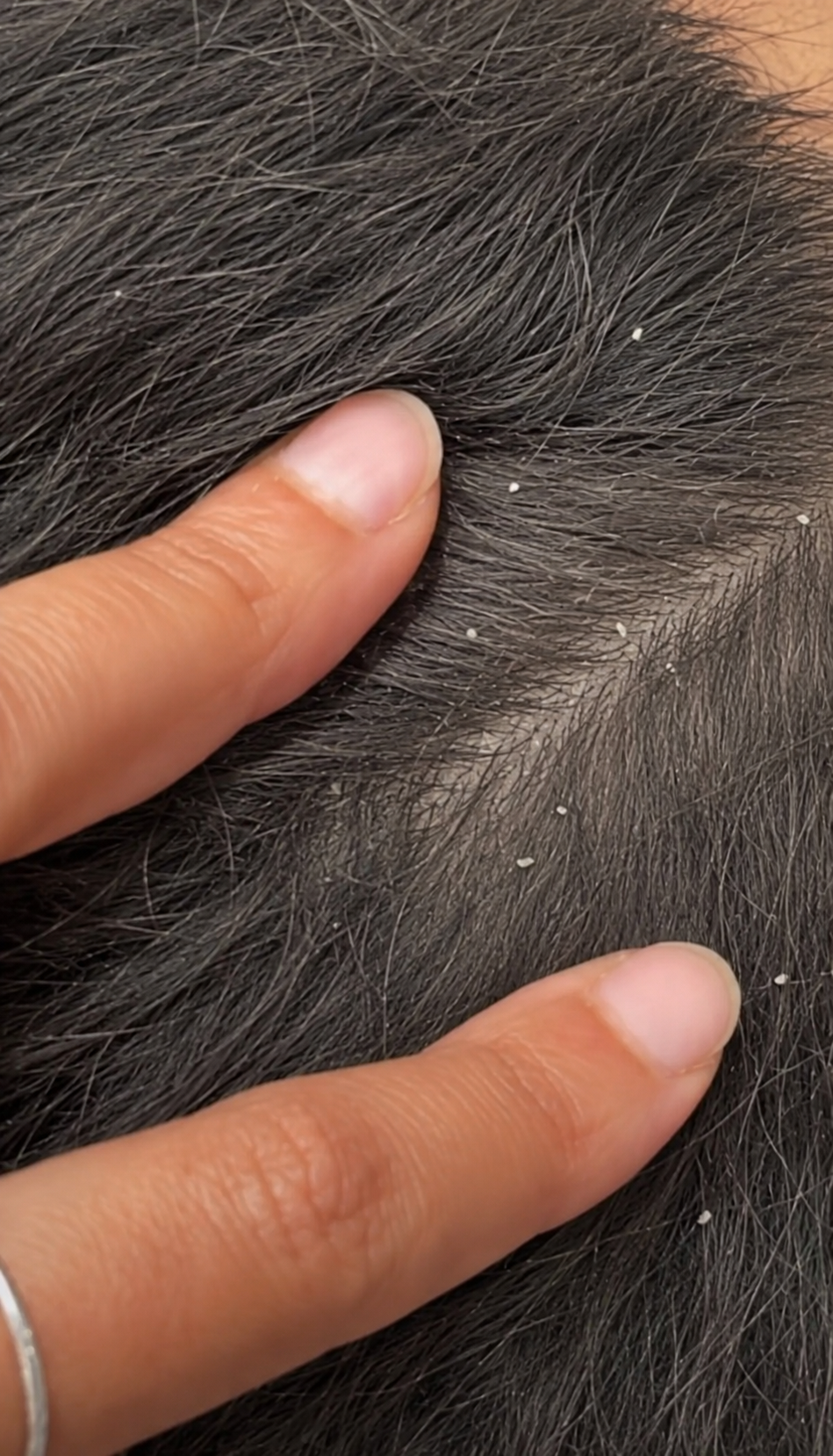 Dandruff vs Dry Scalp: How to Tell the Difference