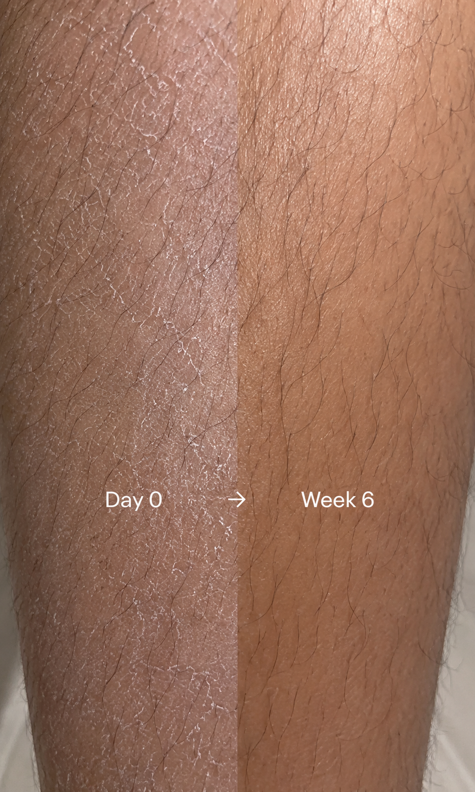 Before and after comparison showing the appearance of dry skin after six weeks of using a SOAH filtered shower head as part of a daily skincare routine